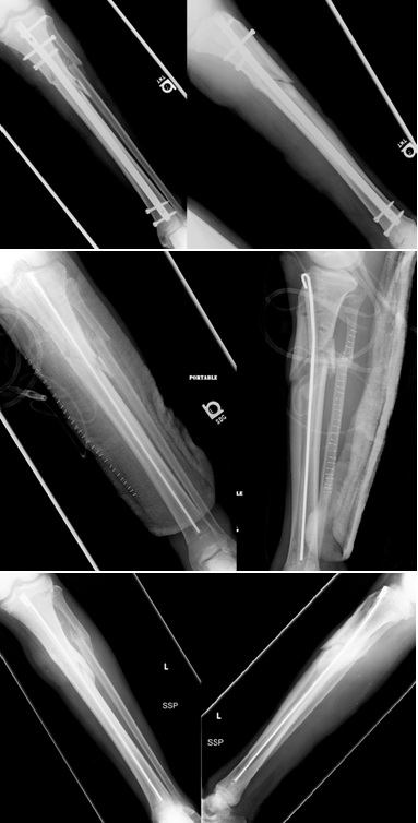 Antibiotic Intramedullary Nail in the Management of Infected Ununited Tibial  Fractures - Case Report, Technique and Review of Literature