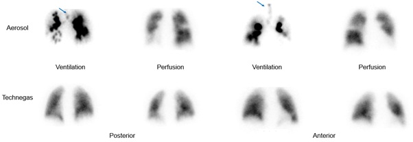 Analysis of the Ventilation Scan in the Evaluation CTEPH