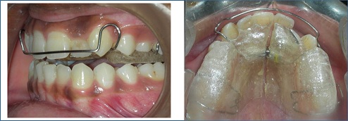 Anterior Crossbite Correction Using a Removable Orthodontic Appliance: A Case Report