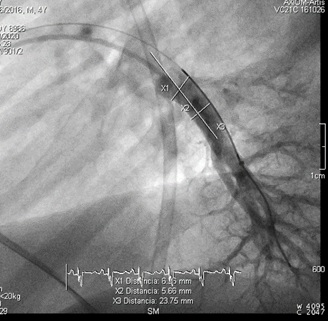 The Utility of the CardioMEMS Device in Pediatrics: A Case of Innovation and Compassion Studied 4 Years after Device Implantation for Remote Pulmonary Artery Monitoring