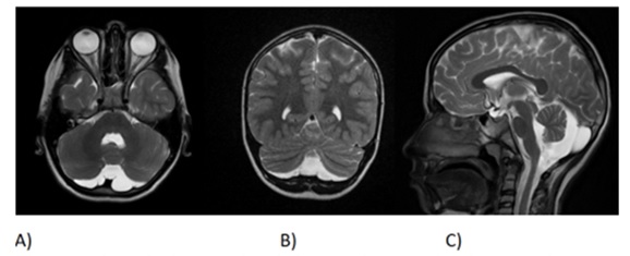 First Turkish Patient Diagnosed with BCL11A-Related Intellectual Disability with A De Novo Pathogenic Variant