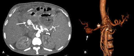 Hepatic Artery Pseudoaneurysm after Hepatic Transplant - Endovascular Treatment with Graft Stenting