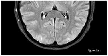Posterior Reversible Leukoencephalopathy Syndrome and Hypertensive Crisis Due to Obstructive Sleep Apnoea during Haemodialysis Sessions