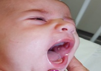 Unilateral Parotitis in Neonatal and Young Children