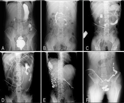 The Incidence Rate of Bacteremia in Patients with Enterocutaneous Fistula and its Influencing Factors