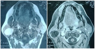 Lipoma of the Parotid Gland Extending from the Superficial to the Deep Lobe: Case Report