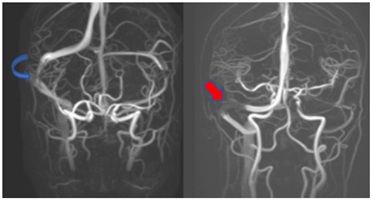 What Should Otolaryngologists Know About Dural Venous Sinus Stenting?