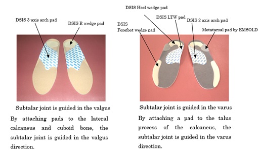 Plantar Inserts Therapy for Hind Foot Subtalar Joint Valgus Type in Medial Gonarthrosis