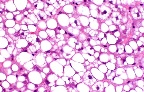 Severe Liver Steatosis from L-Asparaginase May not Recur Following Drug Re-Challenge