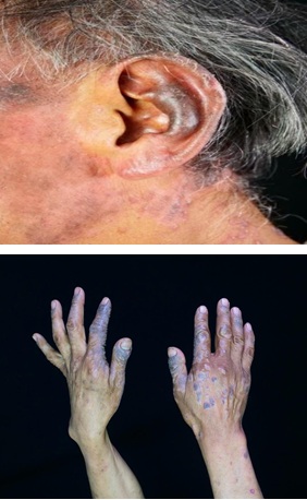 A Black Ear in A HIV Patient