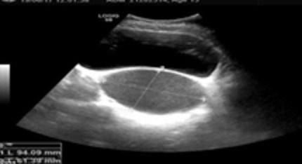 A Case of Hydronephrosis