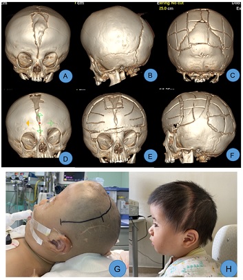 Posterior Cranial Vault Expansion Remodeling for the Treatment of Various Craniosynostosis in Children