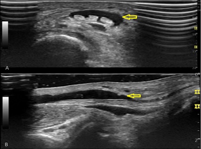 Focal Nerve Compression by Tenosynovitis as a Concomitant Cause of Neuropathic Pain in Guillain-Barré Syndrome: a Case Report