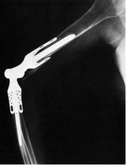 Past, Present and Future of Tea (Total Elbow Arthroplasty)