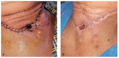 Management of Pharyngocutaneous Fistula Post Total Laryngectomy during COVID-19 Pandemic using Type A Botulinum Toxin (Botox A)