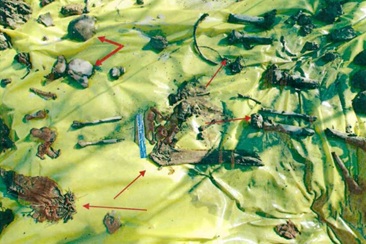 Using a Killer’s Statements as Critical Evidence to Support a Charge of Third-Degree Murder (as Opposed to Self-Defense) When Physical Evidence is Inconclusive: A Case Report