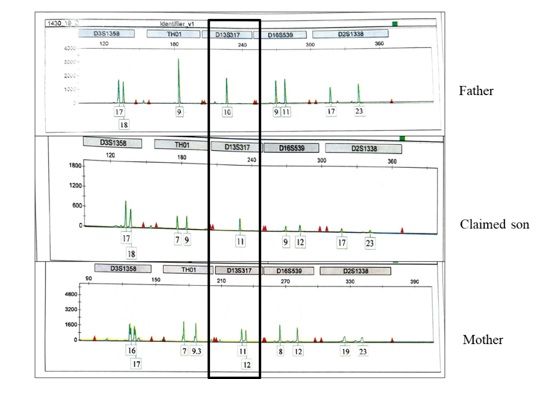 Genetic Incompatibility between Father and Child Due To Maternal Uniparental Isodisomy at Locus D13S317 in A Paternity Testing: A Case Report
