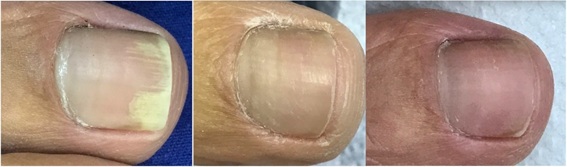 Severe Onychomycosis with Dermatophytoma Successfully Treated with Long Pulsed Nd: Yag Laser