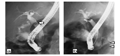 Management and outcome of Endoscopic Retrograde Cholangiopancreatography-Related Duodenal Perforations: How to Determine and What is Recommended for Surgical Treatment?