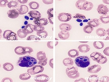 The Critical Role of the Complete Blood Count in the Diagnosis of Candidemia: A Case Report