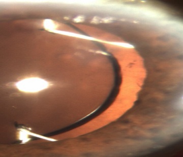 One-Year Postoperative Outcomes following Transfixion of Foldable Intraocular Lens with Polytetrafluoroethylene Suture for Scleral Fixation