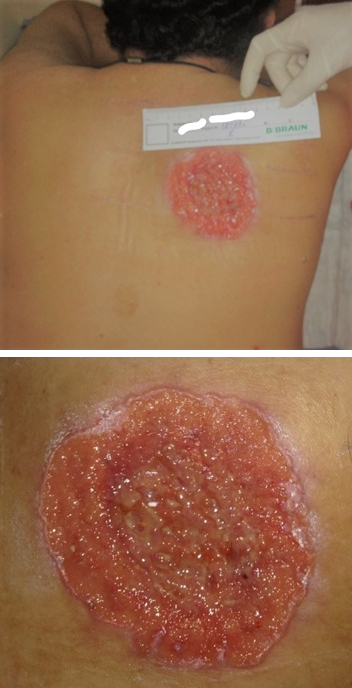 Undiagnosed Hard-to-Heal Wound Cases: A Case Series