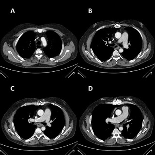 Laparoscopic-Assisted Transhiatal Esophagectomy in Squamous Carcinoma after Bipulmonary Transplant