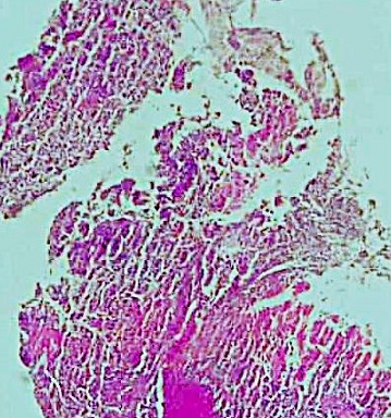 Diagnostic Challenge of Isolated Alpha-Fetoprotein Elevation: A Case Report