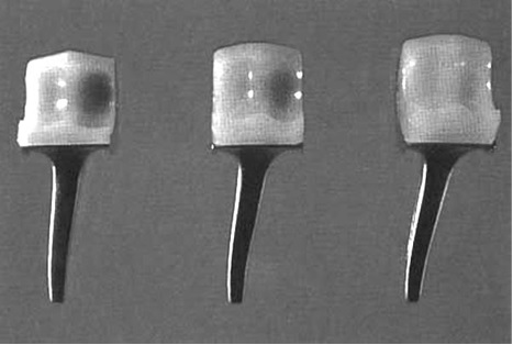 Capitellocondylar (unconstrained) ulnar component