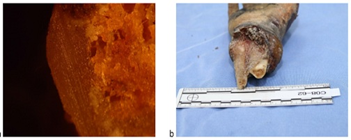 a) Parallel striations seen on the surface of the severed radial bone. Image taken by a Leica LED stereomicroscope [40X]; b) preserved left hand of the victim severed at the distal ulna and radius.
