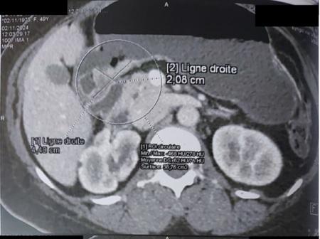 Abdominal CT scan image showing a thickening of the posterior wall of the stomach
