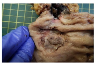  Poorly differentiated, grade III tubular adenocarcinoma of the stomach