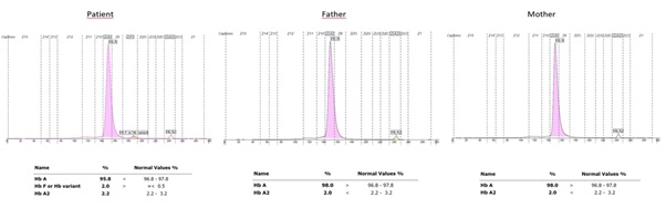 The hemoglobin electrophoresis showed that the patient&rsquo;s HbF value was high; however, the results of the parents were normal.