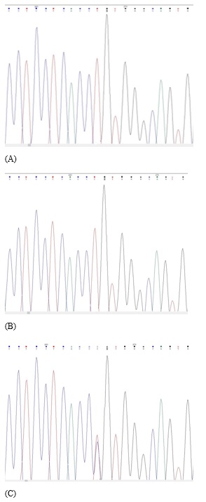 No variant was detected in either parent in the segregation analysis(PM6).