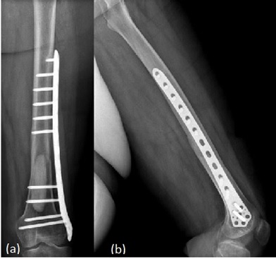 Radiograph of a left distal femoral plate fixation. (a) - Anterior View. (b) - Lateral View