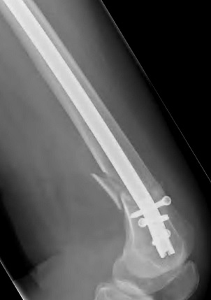 Radiograph of a left retrograde intramedullary nail fixation, lateral view