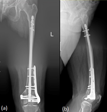 Radiograph of a left combined femoral intramedullary nail and plate fixation. (a) Anterior view. (b) Lateral View