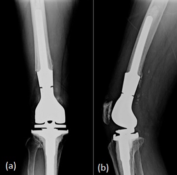 Radiograph of a right distal femoral replacement. (a) Anterior View. (b) Lateral View