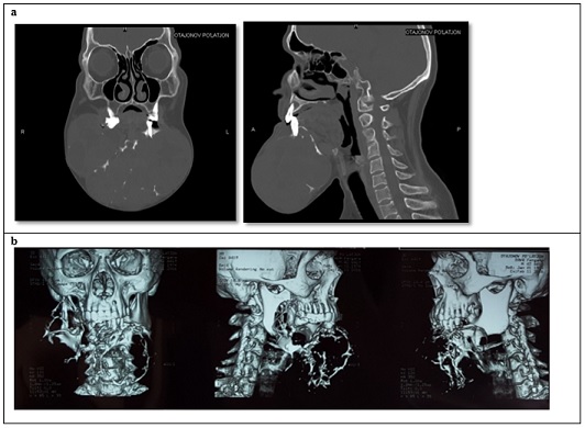 Figure 2a: CT scan in two projections. Large formation in the mandible region. 2b. Three-dimensional reconstruction of the patient's computed tomography scan.
