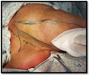 Surgical incisions marked with brilliant green, necessary for exposure of the mandible with the tumor.