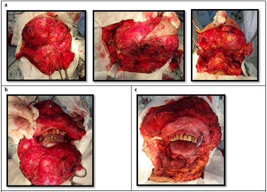 a – stages of tumor exposure; b – dissected tumor; c – surgical defect after subtotal resection of the mandible.