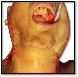 Condition after reconstruction of the postoperative bed with local tissues.