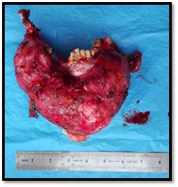 Gross specimen. Resected tumor.