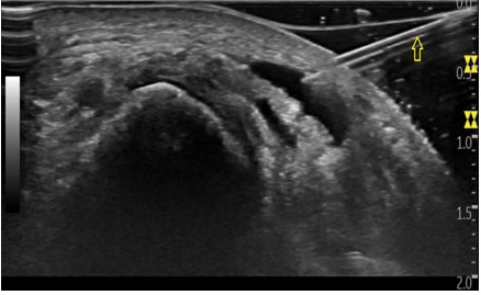 Ultrasound image of the ultrasound-guided intervention on the extensor digitorum longus