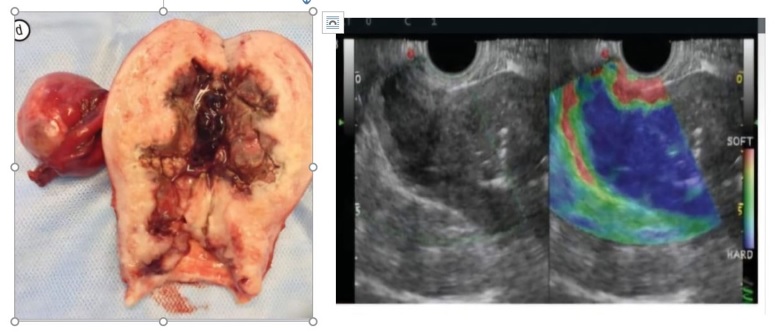 Cancer cervix stage IIa stage