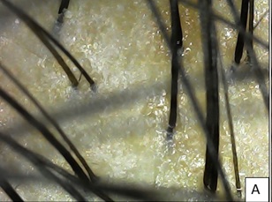 Pt 1 A. At baseline, hair diameter variation with primary roots seen.