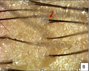 After 1 month of 1st session, few secondary hair follicles (Red arrow) seen with increased hair shaft diameter.