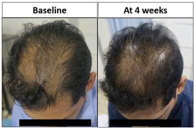 Pt. 8 had significantly increased hair density at vertex region on 4th week from baseline.