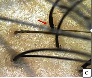 After 1 week of 1st session, Increased hair shaft diameter at base (red arrow) with mild erythema seen.