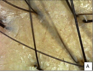 Pt 2 at baseline showing miniaturization of hair with anisotrichosis and sparse density and scaling seen
